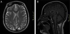 Gadolinium-enhanced brain MRI sequences yielding normal results: (A) axial T2-weighted sequence, (B) sagittal T2-weighted FLAIR sequence.