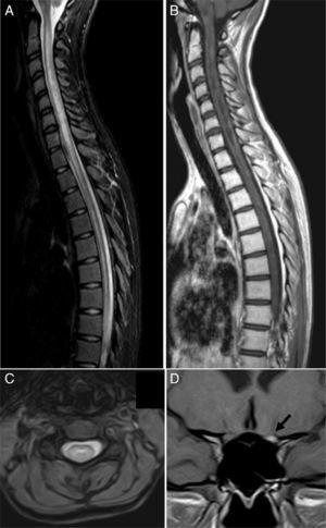 MRI scan at the time of admission. (A) Spinal cord MRI, sagittal fat suppression sequence (STIR), showing increased diffuse signal intensity extending along the spinal cord. (B) Sagittal T1-weighted sequence displaying patchy contrast enhancement along the spinal cord and hypointensities suggesting necrotic lesions in the central region of the spinal cord. (C) Axial T2-weighted sequence showing the central location of the lesion. (D) Coronal T1-weighted sequence revealing marked gadolinium enhancement in the left optic nerve (arrow).