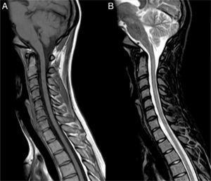 Follow-up spinal cord MRI scan. (A) Sagittal T1-weighted sequence showing spinal cord thinning. (B) Sagittal fat suppression sequence (STIR): spinal cord hyperintensities have disappeared.
