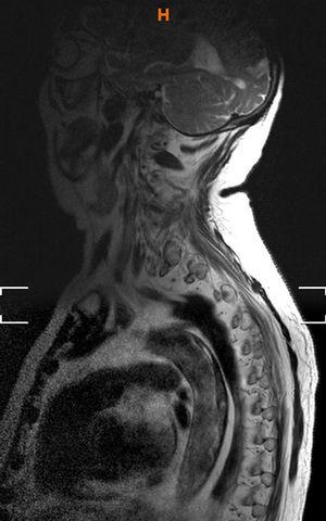Spinal MRI: large thrombus on the posterior wall of the aorta.