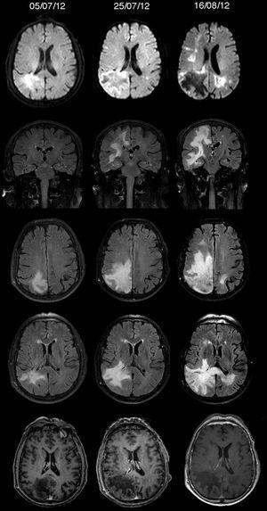 Diffusion-weighted sequences, coronal and axial FLAIR sequences, and gadolinium-enhanced T1-weighted sequences. Timeline of our patient's MR images. The lesion was initially located in the right parieto-occipital area; it was hyperintense on T2/FLAIR sequences, it displayed no contrast uptake or mass effect, and was bright on diffusion-weighted images. In about a month, the lesion progressed from focal to multifocal, affecting the corpus callosum and cortex.