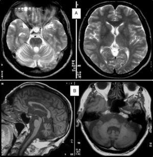 A) T2-weighted MRI scan of a 52-year-old patient with SCA36 showing no white matter lesions or cortical atrophy; diffuse cerebellar atrophy may be seen. B) T1-weighted MRI scan of an 86-year-old patient with SCA36 showing olivopontocerebellar atrophy.