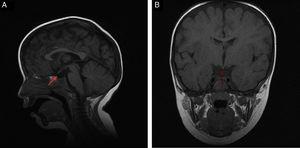 T1-weighted brain MRI: sagittal (A) and coronal (B) slices. Moderate anterior pituitary hypoplasia, ectopic posterior pituitary at the median eminence, and complete agenesis of the pituitary stalk.