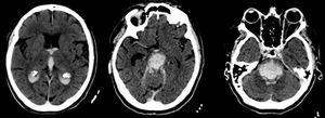 Large brainstem haematoma affecting the pons and extending to the midbrain, diencephalon, third and fourth ventricles, and lateral ventricles. Hyperdense right middle cerebral artery.