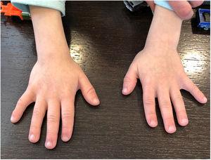 Small hands with brachydactyly (especially in distal phalanxes) and clinodactyly.