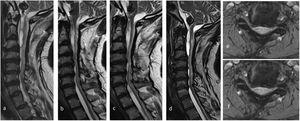 The MRI study showed cervical spondylotic myelopathy with disc degeneration in at least 5 intervertebral spaces, with hypertrophy and calcification of the posterior longitudinal ligament. These lesions caused stenosis of the cervical spinal canal. T2-weighted axial and sagittal sequences show the progression of the multiple arachnoid cysts and trabeculae from the craniocervical junction to the C7 level, with severe compression and atrophy of the spinal cord. Postoperative images obtained in a) 2014, b) 2015, c) 2016, d) 2018, e) 2014, and f) 2018. Gutiérrez et al.