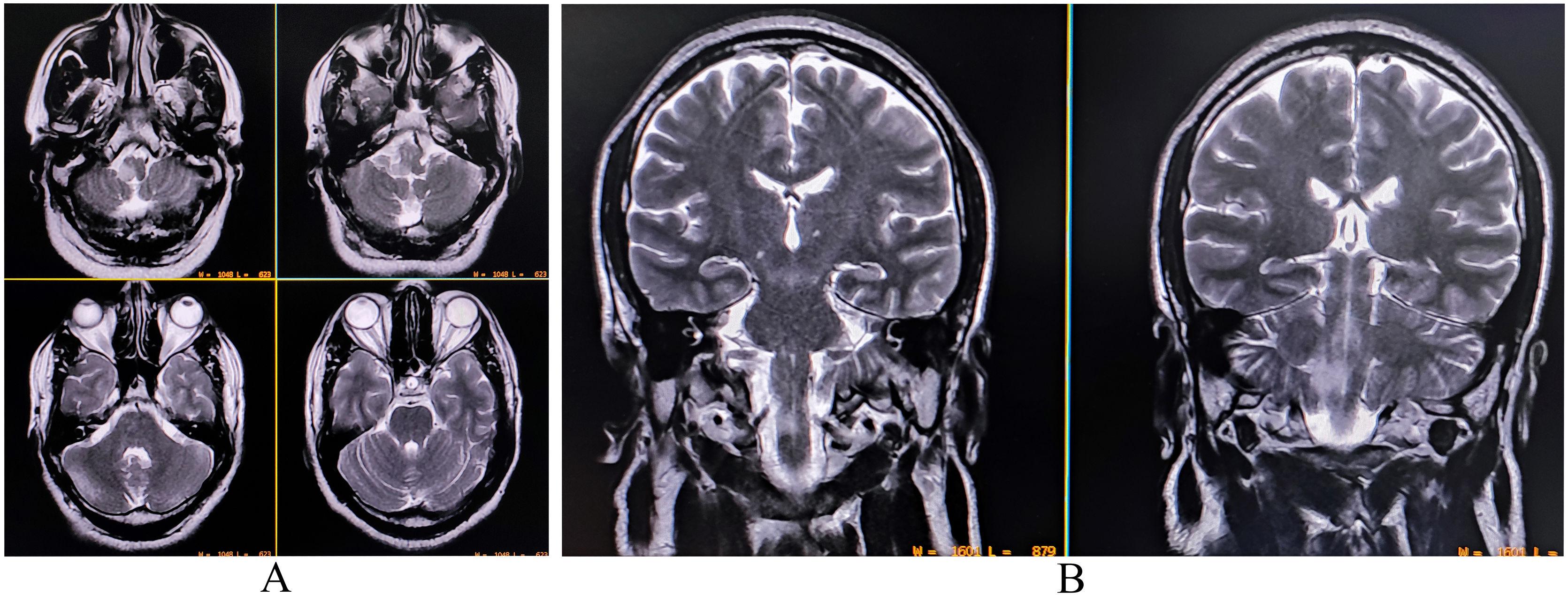 Sertraline 100mg ocd