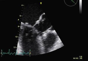 Transesophageal echocardiogram showing systolic anterior motion of the mitral valve anterior leaflet.