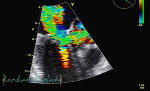 Transesophageal echocardiogram, with Doppler study of the left ventricular outflow tract.