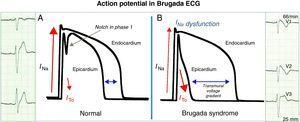 A: In healthy individuals, there is a small notch in phase 1 of the ventricular action potential mediated by the ITO current that is more evident in the epicardium and is not visible on the ECG. B: In Brugada syndrome, an ionic imbalance in phase 1 favoring repolarization in the epicardial surface generates a transmural voltage gradient, seen on the ECG as type 1 repolarization pattern.