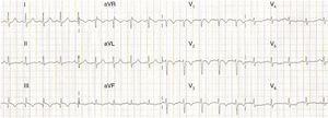 ECG showing sinus tachycardia, S1Q3T3 pattern and T-wave inversion in V1–V4, probably related to ischemia and/or overload in the right ventricle and the ventricular septal region.