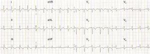 ECG showing sinus tachycardia, S1Q3T3 pattern and T-wave inversion in V1–V4, probably related to ischemia and/or overload in the right ventricle and the ventricular septal region. ECG showing sinus tachycardia, S1Q3T3 pattern and T-wave inversion in V1–V4, probably related to ischemia and/or overload in the right ventricle and the ventricular septal region.
