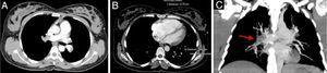 (A) Occlusive thrombus in the right pulmonary artery extending to the lobar branches. An occlusive thrombus can be seen on the left in the superior lobar artery extending to the left pulmonary artery. Another thrombus is visible in the inferior lobar artery, not completely occlusive, extending into the segmental branches; (B) right ventricle measuring 57mm and left ventricle measuring 29mm; (C) coronal plane reconstruction with a thick slice (24mm) in maximum intensity projection, showing thrombus in the right pulmonary artery (red arrow). (A) Occlusive thrombus in the right pulmonary artery extending to the lobar branches. An occlusive thrombus can be seen on the left in the superior lobar artery extending to the left pulmonary artery. Another thrombus is visible in the inferior lobar artery, not completely occlusive, extending into the segmental branches; (B) right ventricle measuring 57mm and left ventricle measuring 29mm; (C) coronal plane reconstruction with a thick slice (24mm) in maximum intensity projection, showing thrombus in the right pulmonary artery (red arrow).