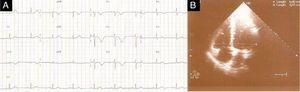 (A) ECG showing sinus bradycardia of 58bpm, absence of S wave in DI and T-wave inversion in V1–V4. (B) Transthoracic echocardiography in end-diastolic apical 4-chamber view showing right/left ventricle ratio <1 and pulmonary artery systolic pressure of 25mmHg.