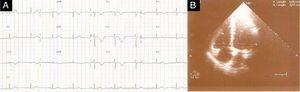 (A) ECG showing sinus bradycardia of 58bpm, absence of S wave in DI and T-wave inversion in V1–V4. (B) Transthoracic echocardiography in end-diastolic apical 4-chamber view showing right/left ventricle ratio <1 and pulmonary artery systolic pressure of 25mmHg. (A) ECG showing sinus bradycardia of 58bpm, absence of S wave in DI and T-wave inversion in V1–V4. (B) Transthoracic echocardiography in end-diastolic apical 4-chamber view showing right/left ventricle ratio <1 and pulmonary artery systolic pressure of 25mmHg.