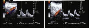 Lower limb arterial Doppler ultrasound showing symmetrically decreased systolic pressure index (1) and persistent blood flow during diastole (2).