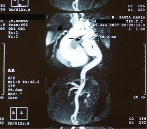 MRI angiography showing a thoracic aortic coarctation (arrow) with large poststenotic dilation (1), hypoplastic abdominal aorta (2) and enlarged internal mammary artery (arrowhead).