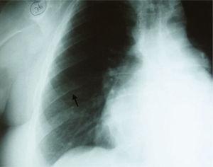 Chest radiograph with inferior rib notching (arrow).