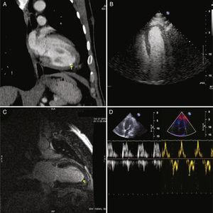 Imaging studies performed to establish diagnosis of endomyocardial fibrosis: Thoraco-abdominal CT (A), transthoratic contrast echo (B, C), and cardiac MRI (D).