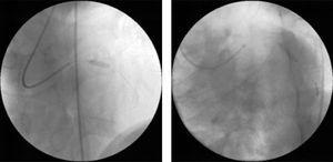 Percutaneous coronary intervention with direct stenting of the lesions observed on diagnostic angiography: 3mm×12mm DRIVER stent in the proximal left anterior descending artery (left) and 3mm×15mm DRIVER stent in the mid circumflex artery (right).