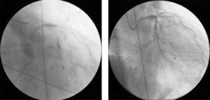 (A) Retention of contrast at various points of the coronary tree and abrupt reduction of coronary flow (TIMI 0/1); (B) restoration of coronary flow (TIMI 3) and resolution of severe diffuse vasospasm in the left coronary tree following administration of intracoronary verapamil.