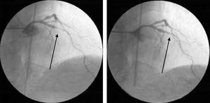 Invasive coronary angiography during the latest hospitalization, showing severe coronary spasm of the mid left anterior descending artery, which resolved after administration of intracoronary nitrates.