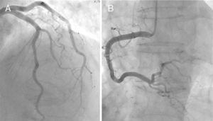 Cardiac catheterization in a patient with takotsubo cardiomyopathy showing normal coronary arteries. (A) Left coronary artery; (B) right coronary artery.