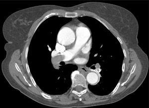 Embolus in the right pulmonary artery and left lower lobe.