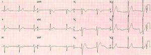 ECG showing J-point elevation in V1 with downsloping ST, and horizontal ST-segment elevation in V2.
