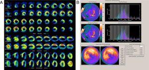 Gated SPECT myocardial perfusion images (A) of a patient with an extensive fixed perfusion defect (fibrosis) and corresponding dyssynchrony analysis showing the polar map and phase histogram with a wide base and SD of 54.6° (B).