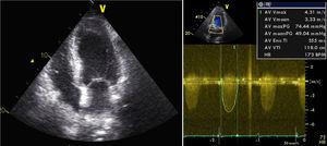 Transthoracic echocardiogram showing a non-dilated left ventricle with mild hypertrophy of the ventricular septum and good global systolic function, with a peak valve gradient of 74 mmHg and mean gradient of 49 mmHg.