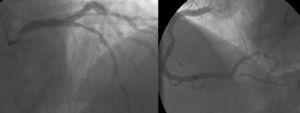 Coronary angiography showing two-vessel disease (75% lesion in the mid left anterior descending and 90% lesion at the origin of the posterior descending artery).