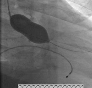 Aortic balloon valvuloplasty with a 20-mm NuCLEUS balloon under pacing rhythm at 220 bpm.