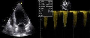 Transthoracic echocardiogram showing moderate to severe left ventricular global systolic dysfunction and aortic valve gradient of 31 mmHg.