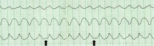 Wide QRS tachycardia with evidence of AV dissociation (arrows: P waves), indicative of ventricular origin.