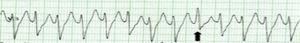 Wide complex tachycardia in which the presence of a fusion complex (arrow) indicates a diagnosis of ventricular tachycardia.