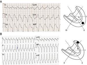 Determining the origin of ventricular tachycardia according to QRS axis. (A) In ventricular tachycardia with apical origin the axis of ventricular depolarization is directed superiorly, and so the QRS complexes are negative in DII, DIII and aVF; (B) a ventricular tachycardia with basal origin results in positive QRS complexes in DII, DIII and aVF (adapted with permission from Wellens2).