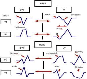 Morphological criteria in leads V1 and V6 for differential diagnosis of wide QRS tachycardia. LBBB: left bundle branch block; RBBB: right bundle branch block; SVT: supraventricular tachycardia; VT: ventricular tachycardia.