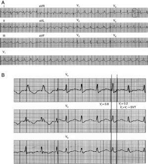 Application of the vi/vt criterion. (A) 12-lead ECG trace of wide QRS tachycardia. vi is measured in a lead showing a biphasic or multiphasic QRS with the most rapid activation velocity. A QRS complex in this lead is selected in which the beginning and end of the complex are clearly visible. (B) Vertical lines mark the beginning and end of the selected QRS complex and small red stars mark the first and last 40ms of the complex. During the first 40ms, the impulse shifts vertically by 0.8mV and thus vi=0.8; during the last 40ms it shifts vertically by 0.2mV and so vt=0.2mV. The vi/vt ratio therefore suggests a diagnosis of supraventricular tachycardia (adapted with permission from Vereckei et al.18).