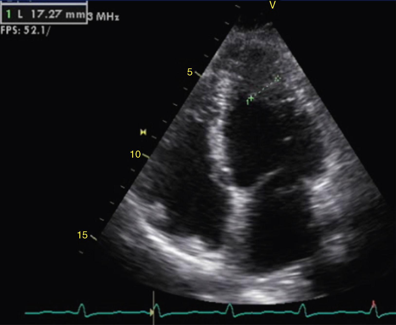 Echocardiography in Anderson-Fabry Disease