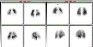 Perfusion (left) and ventilation (right) scan. Multiple perfusion defects in both lungs with normal ventilation study.