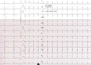 12-lead ECG obtained during sinus rhythm, showing a normal PR interval with no delta waves. Tachycardia is then induced with a single extra beat from the right ventricular apex, exhibiting narrow QRS complexes, long RP intervals, and inverted P waves in the inferior leads, I and aVL and positive in V1.