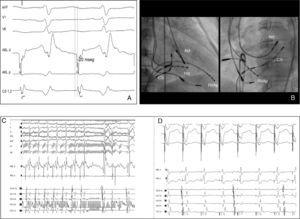 (A) Successful ablation site. The ablation catheter electrogram during tachycardia showed early atrial activation preceding P-wave onset by 15–20 ms, A/V ratio >2; (B) radiograms obtained in right anterior oblique (30°) and left anterior oblique (45°) projections showing the successful ablation site in the left lateral region at the mitral annulus; (C) the tachycardia was terminated within four seconds of radiofrequency application; (D) absence of ventriculoatrial conduction after ablation. Abbreviations as for Figure 2.