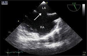 Transesophageal echocardiographic image of atrial septal defect (arrow). LA: left atrium; RA: right atrium.