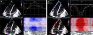 Right atrial (A) and right ventricular (B) strain measurements by two-dimensional speckle tracking echocardiography.