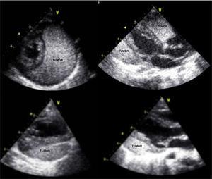 Echocardiograms comparing day 1 of life (above) and last review at nine months of age (below) showing significant regression of the tumor and no pericardial effusion.