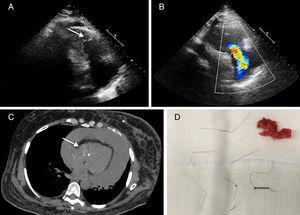 Echocardiogram showing hyperechoic linear images in the right chambers (A) and severe tricuspid regurgitation (B); chest computed tomography demonstrating intracardiac metallic fragments (C); thrombus and IVC filter fragments removed (D).