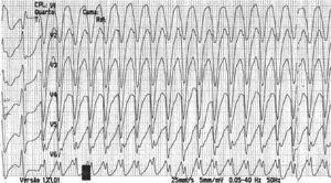 Rhythm strip recording monomorphic ventricular tachycardia with pattern of left bundle branch block and rate of around 300 bpm.