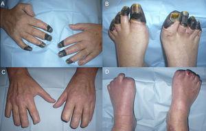 (A and B) Severe dry necrosis extending to both hands and feet; (C and D) postoperative result after extensive amputation.