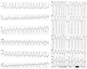12-lead ECG: MAP-mediated pre-excited atrial fibrillation: irregular tachycardia, 230 bpm, with widened QRS complexes of varying morphologies (especially in V4 and V5). MAP: Mahaim accessory pathway.